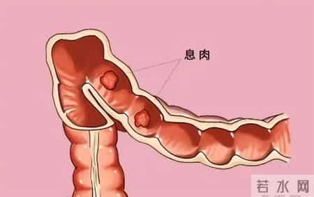 研究发现：一旦做了息肉切除手术，这6件事要注意，要切记！