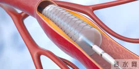 心脏支架一放，人生倒计时就开始了？医生说出实话：这6点要注意