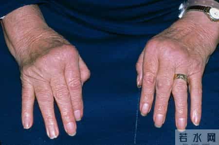 专家研究：每天多吃一个鸡蛋，糖尿病和类风湿或会增加？可信吗