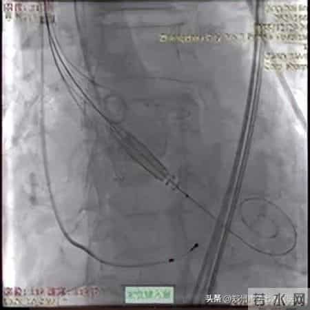 全国首批！心脏瓣膜置换开启新时代
