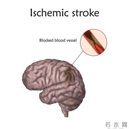 杭州一66岁大妈喜欢睡前泡脚，不久脑梗去世，医生怒斥：太无知了