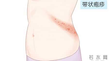 带状疱疹治疗有讲究！不同人群对应不同方案，别盲目用药