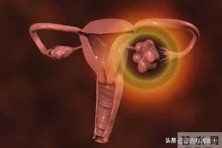 84%患者获益，生存期最长超44个月！罕见卵巢癌终于迎高效新方案