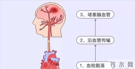 房颤引发卒中 3 预警信号！忠告：出现一个就就医，别错过救治时机