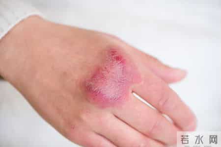 人不会平白无故患带状疱疹？医生：患带状疱疹，或有5个隐藏原因