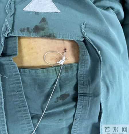 延大咸阳医院首例脊髓神经刺激器置入术成功实施——七旬老人告别“带状疱疹后遗神经痛”