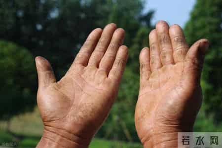 糖尿病人双手3个表现，代表你身体出现3大问题，每1个都不是小事