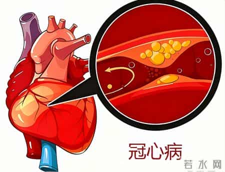 白酒再次成为关注中心！医生发现：冠心病喝白酒时，多留意6点！