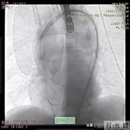 全国首批！心脏瓣膜置换开启新时代