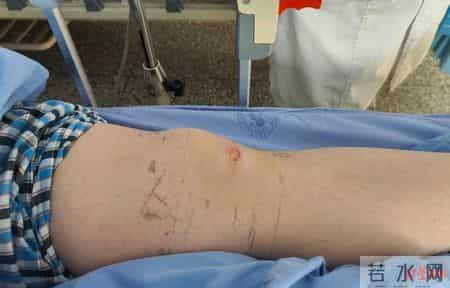 女子睡觉用暖宝宝暖脚被烫伤，创口感染现“深坑”！医生：冬季低温烫伤高发，取暖莫大意