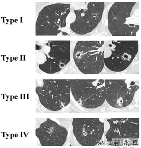 这种类型的肺癌，不仅充满风险，而且神秘莫测！