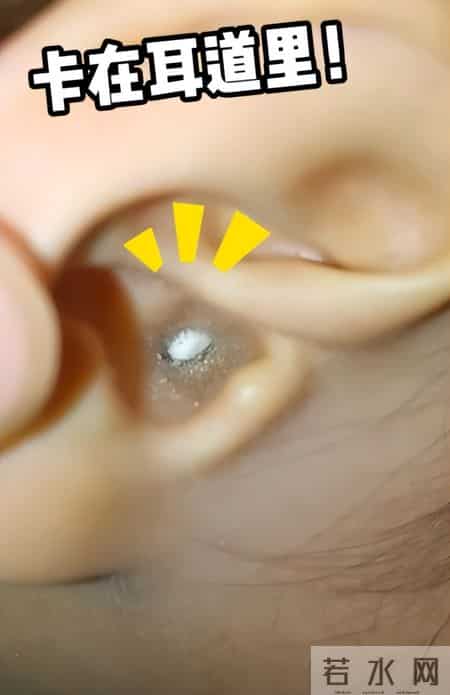 河南妈妈神操作！挖耳朵进沙求医无果，热熔胶牙签上阵成功取出