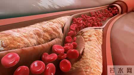 间隔一天吃他汀，降脂效果更好？医生建议：服用他汀，谨记这7点