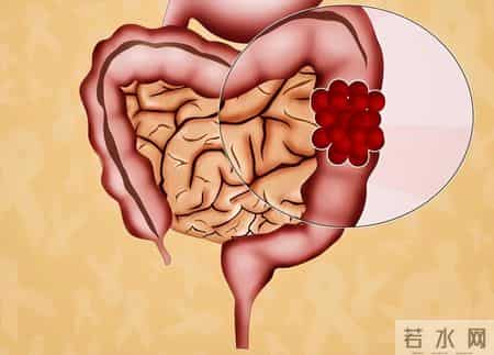 肠息肉不能吃红薯？医生反复提醒：想避免复发，3样食物得慎吃