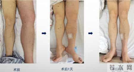 为深静脉血栓治疗提供新路径！仁济医院血管外科张岚团队运用“顺逆结合”介入疗法