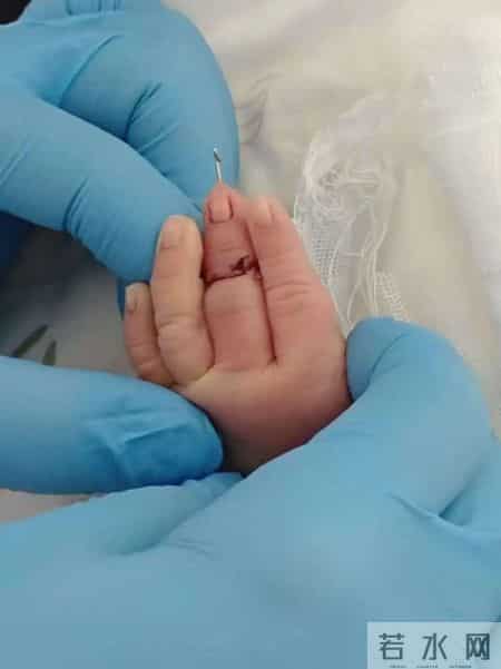 新生儿剪脐带时被剪断手指，医院的一系列操作让人疑惑！