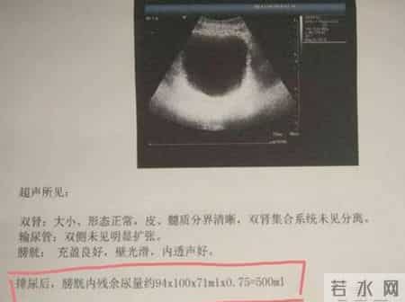 多名医生提醒：只要做过前列腺B超，中老年男性务必重视这3指标！