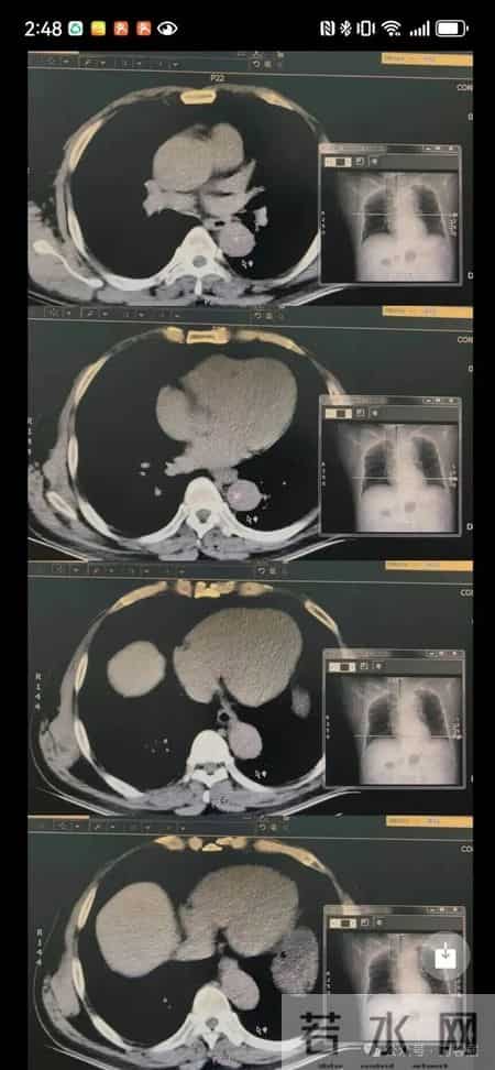 患者自述椎间盘犯了，住院后猝死，检查已做，报告未出，谁之责？