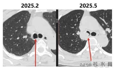 这种类型的肺癌，不仅充满风险，而且神秘莫测！