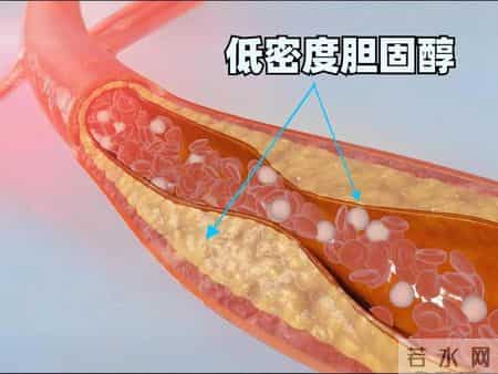 医生坦言：只要血脂报告里没有这几个词，血管健康就不用太担忧