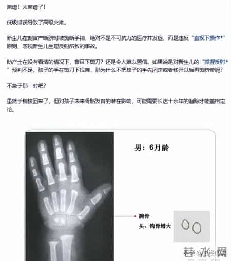 剪脐带剪到手指？1张新生儿“劫难图”，护士一句“乱动”想翻篇