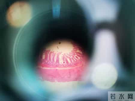 研究发现：一旦做了息肉切除手术，这4件事要注意，要切记！