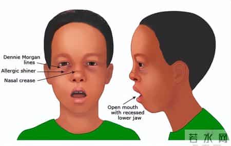 孩子睡觉总张嘴？腺样体面容真会变丑？医生拆解3大认知误区