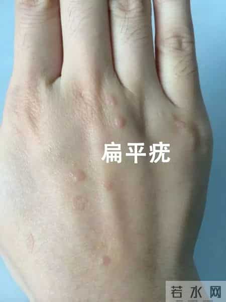 脸上、手背冒出的“小疙瘩”是啥？商丘专家详解扁平疣的防与治