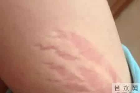 以为骨质疏松，结果是肺癌！这3种腿部表现，可能是肺在“求救”