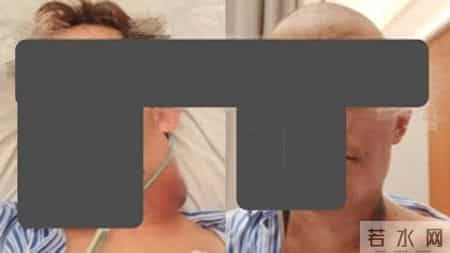 多学科协作，上海九院助33岁极晚期舌癌患者闯过生死关