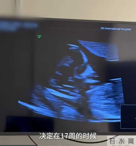 程晓玥透露二胎因吃药导致NT异常！羊水穿刺伤口令人心疼