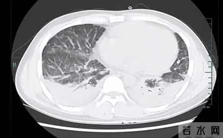 男子为滋补身体吃了它，突然高烧近40℃，肺都“烂穿”！医生：有极大风险……