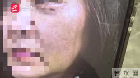 贵阳女子割眼袋遭灼伤，留疤五年未修复，整形医院突然撂挑子！面对记者质疑，经理扬言：还制约不了你们？