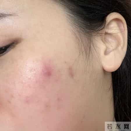 5 个治疗痤疮的经典中药方剂