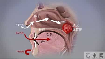 孩子睡觉总张嘴？腺样体面容真会变丑？医生拆解3大认知误区