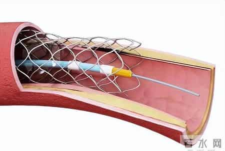 心梗后坚决不放支架会怎样？医生实话实说：两种结局，没有中间路