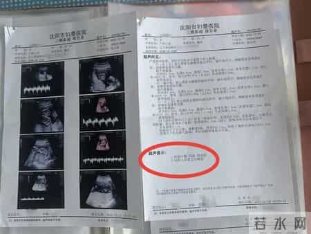 一孕妇两个月内从一胎变四胞胎，每次产检都发现多出一胎，医生：相当罕见