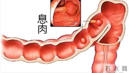 研究发现：一旦做了息肉切除手术，这6件事要注意，要切记！