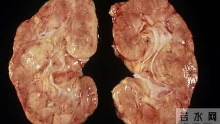 这几种“美食”，正在悄悄拖垮你的肾！第 1 个很多人常吃