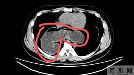 广州28岁小伙总是嗳气烧心，体检也没查出问题，没想到是半个胃“钻”到了胸腔里