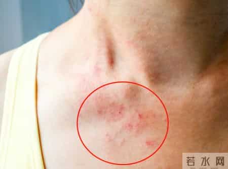 得了性病，身上这5个部位可能会长疹子，建议及时做这5个检查