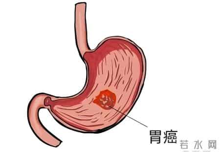 化疗次数越多，转移就越快？这5类癌症患者需严格控次！