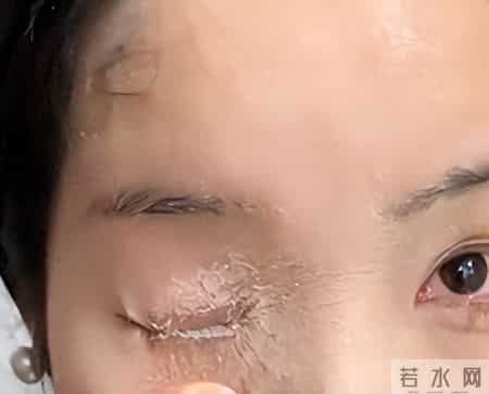 贵州贵阳一女子用502胶水贴指甲片，不慎把眼睛、鼻子粘住，当事人表示：非常痛苦，有严重的濒死感