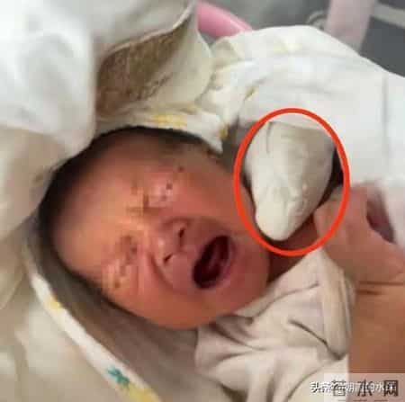 离谱！婴儿刚出生手指被当脐带剪断，全家心碎