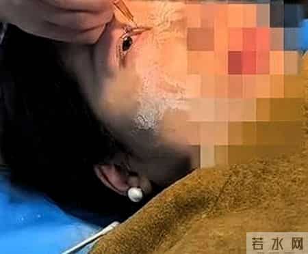 惊人意外！女子贴指甲片不慎打翻502胶水，眼睛、鼻孔全粘住！