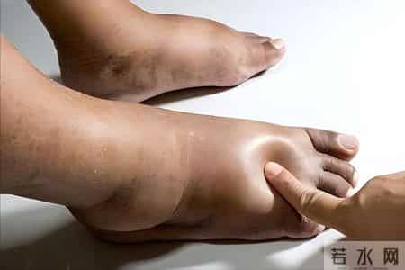 调查发现：肾病患者若经常吃芋头，过不了多久，身体或有6改善