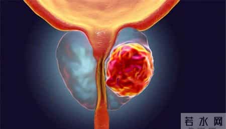 身体4处“胀痛”前列腺癌“警示”，不论排尿正常与否，要尽早查