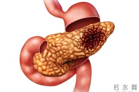全球四分之一胰腺癌在我国，提醒：不想胰腺受伤，4种零食要少吃