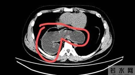 广州28岁小伙总是嗳气烧心 体检也没查出问题，没想到是半个胃“钻”到了胸腔里