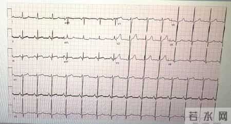 男子误把胸痛当 “过劳”  西安高新医院查出致命心梗